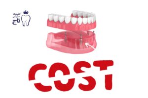 قیمت دندان مصنوعی ثابت بر پایه ایمپلنت
