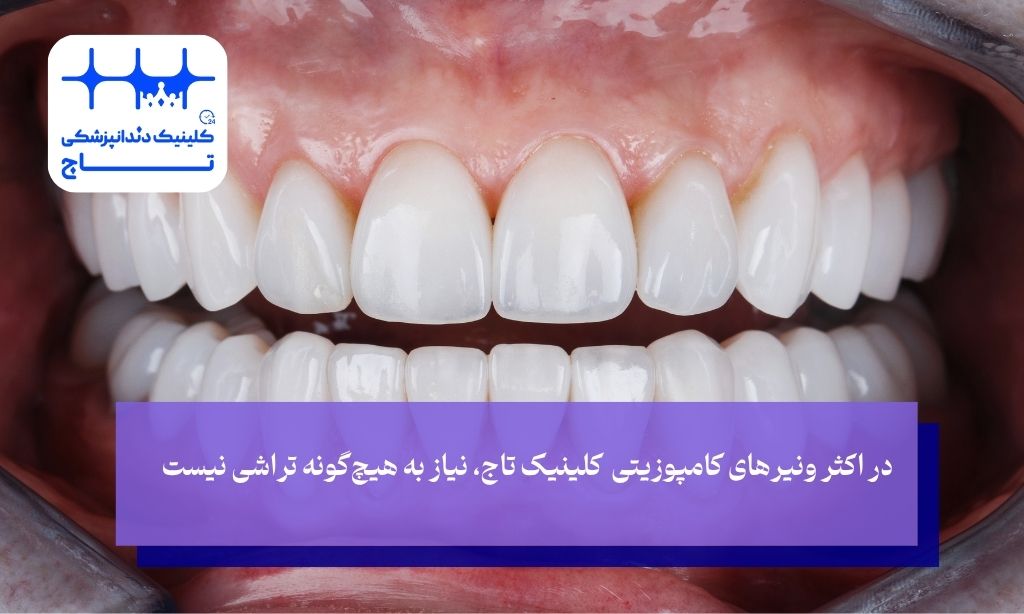 مرحله سوم آماده‌سازی سطح دندان؛ یک شروع محافظه‌کارانه و ایمن