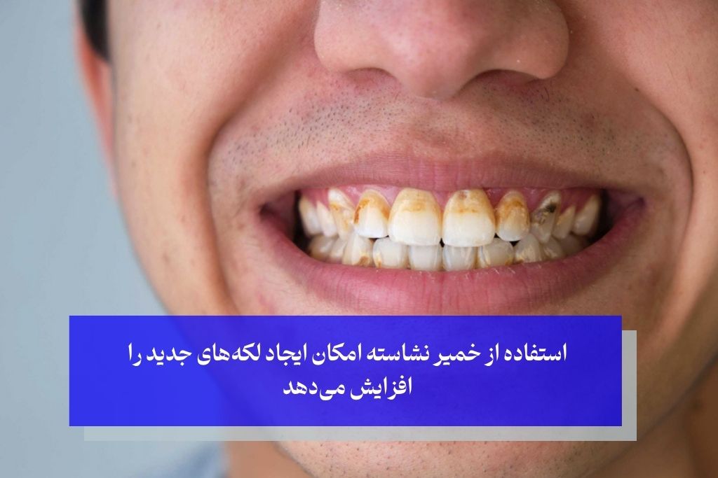 مضرات سفید کردن دندان با نشاسته