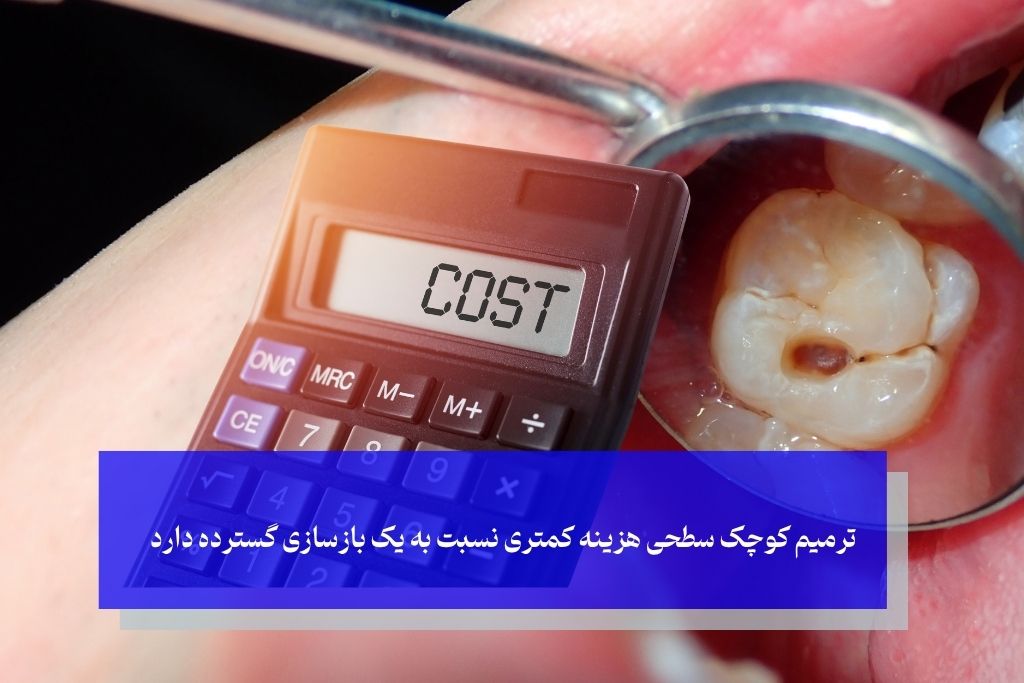هزینه ی ترمیم کامپوزیت دندان