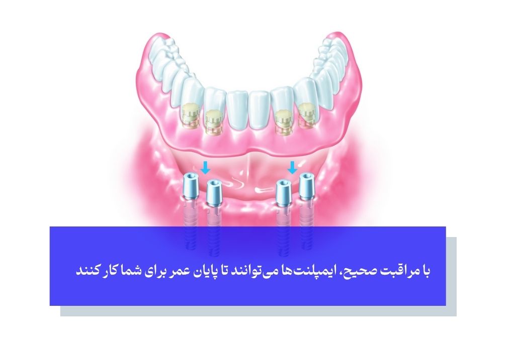چرا پرداخت قیمت دندان مصنوعی ثابت بر پایه ایمپلنت یک سرمایه‌گذاری است؟ بررسی ارزش بلندمدت درمان