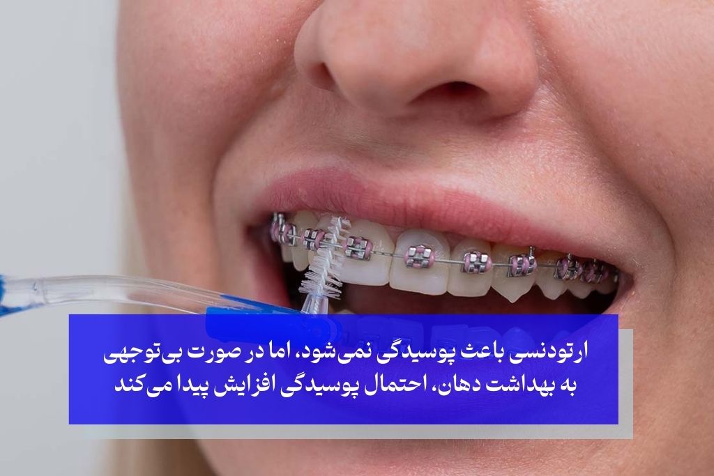 آیا ارتودنسی باعث پوسیدگی دندان میشود