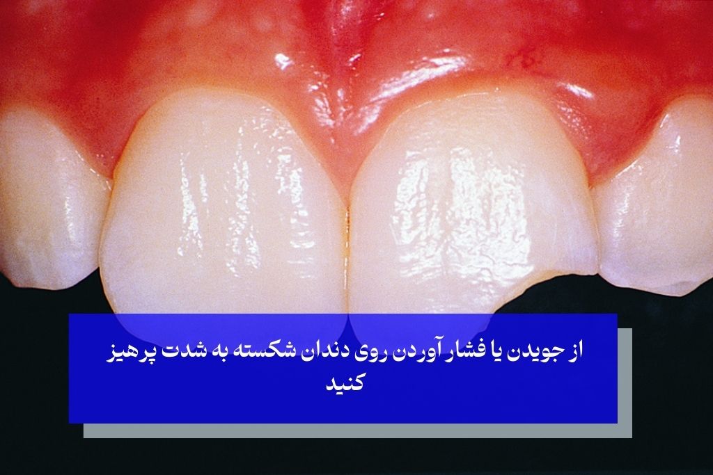 با دندان شکسته چه کنم