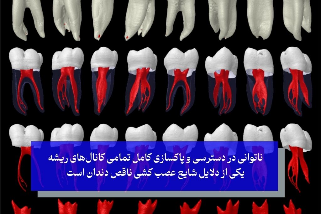 دلایل شایع عصب کشی ناقص دندان