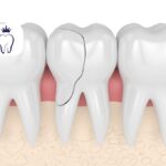 شکستن دندان آسیاب