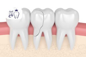 شکستن دندان آسیاب