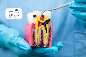 عصب کشی ناقص دندان