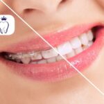 کامپوزیت بهتر است یا ارتودنسی