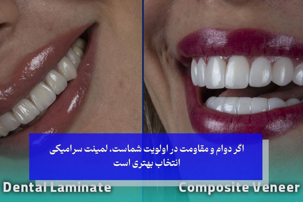 کامپوزیت بهتر است یا لمینت؟