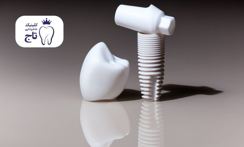 مینی ایمپلنت