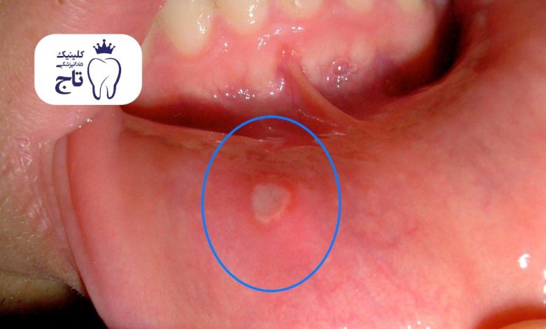 جوش داخل دهان جوش داخل دهان
