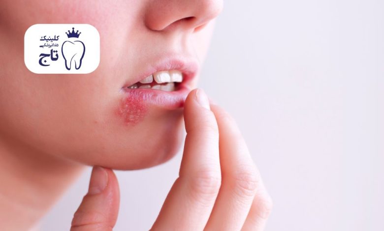 تبخال دهان تبخال دهان