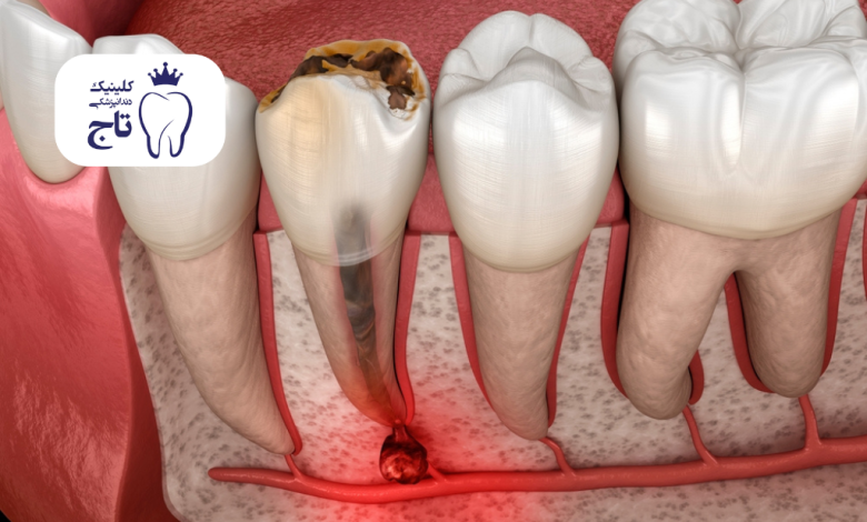 عفونت ریشه دندان