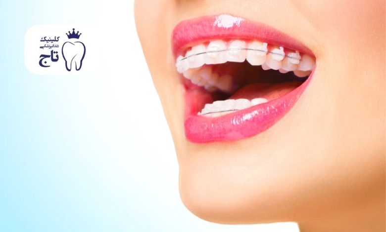 ارتودنسی سرامیکی ارتودنسی سرامیکی