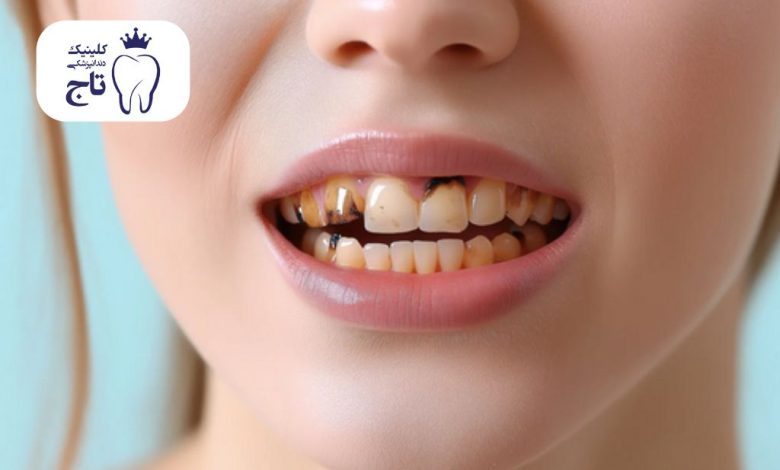 سیاه شدن دندان