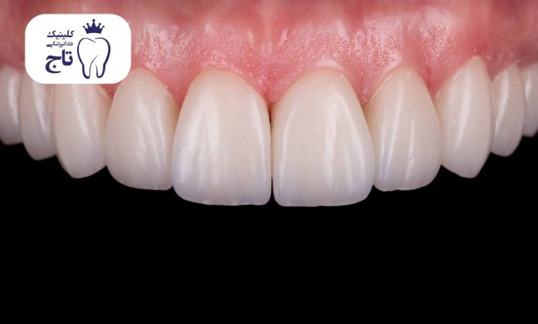 کامپوزیت شیشه ای