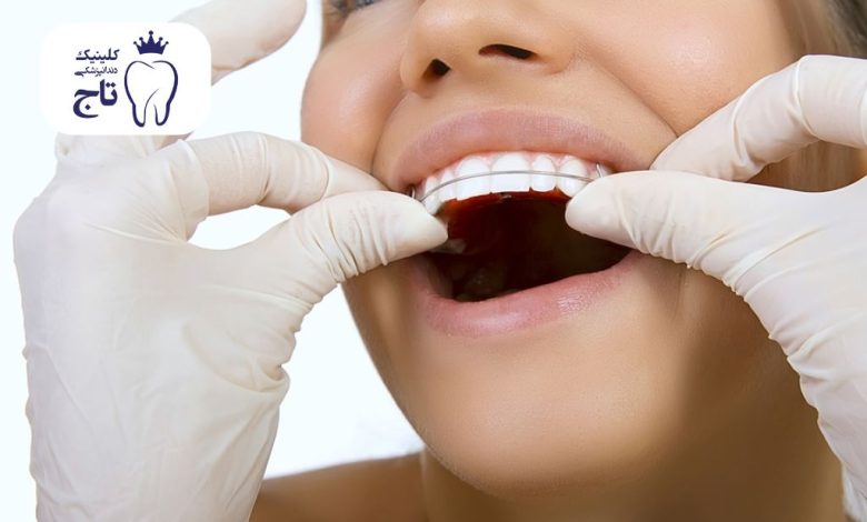 ارتودنسی فانکشنال