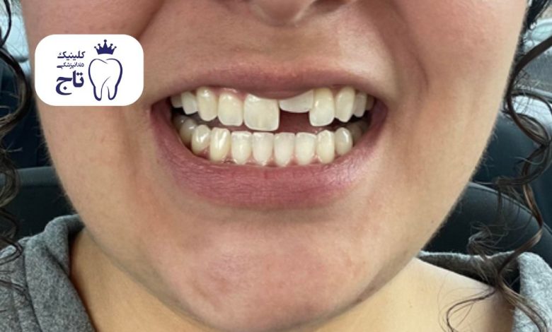 دندان فک جوش