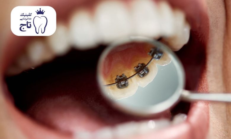 ارتودنسی لینگوال