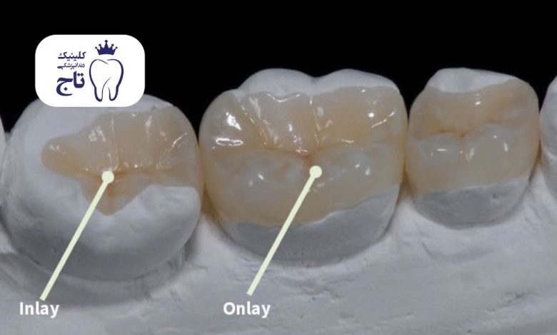 اینله و آنله دندان