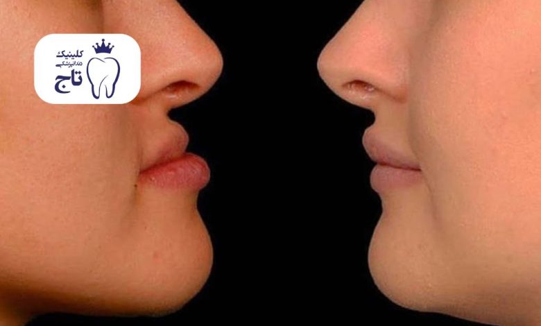 ارتودنسی و لاغری صورت