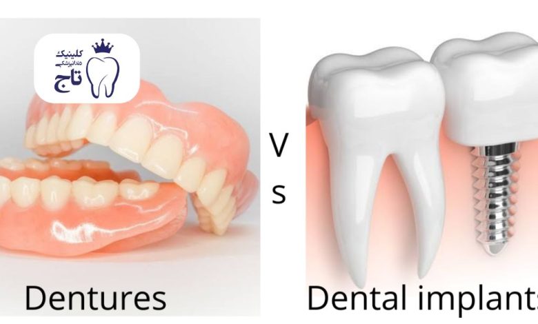 دندان چسبی بهتر است یا ایمپلنت