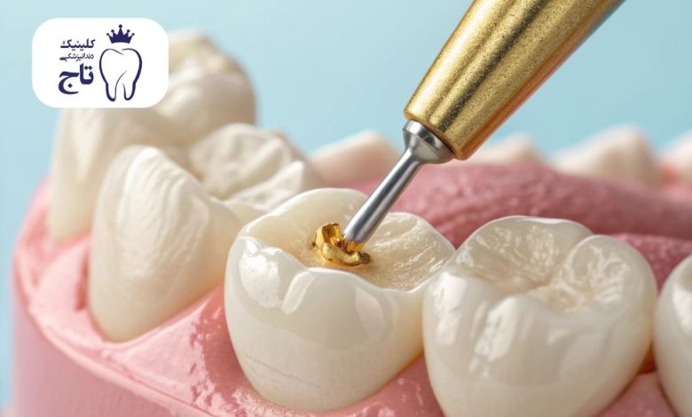 ترمیم کامپوزیت دندان