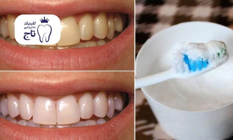 سفید کردن دندان با جوش شیرین