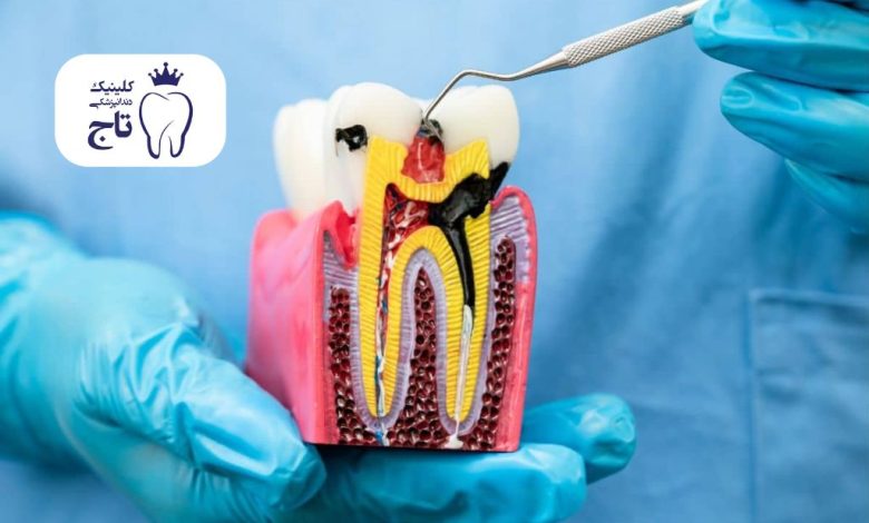 عصب کشی ناقص دندان