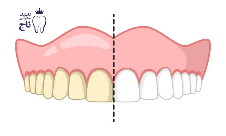 سفید کننده دندان