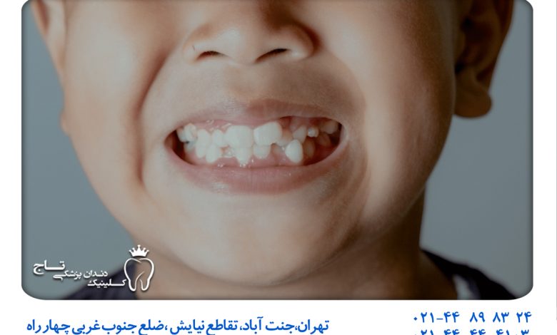 هایپردونتیا ( دندان اضافی کودکان)