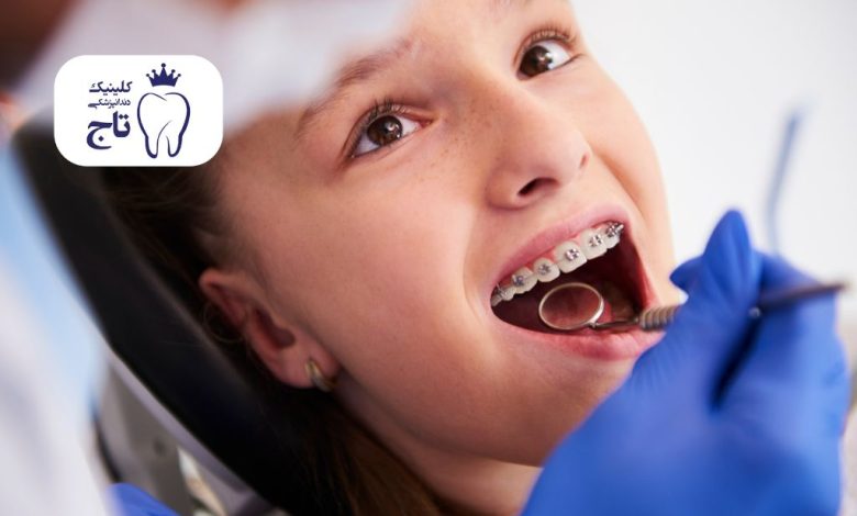 ارتودنسی ثابت ارتودنسی ثابت