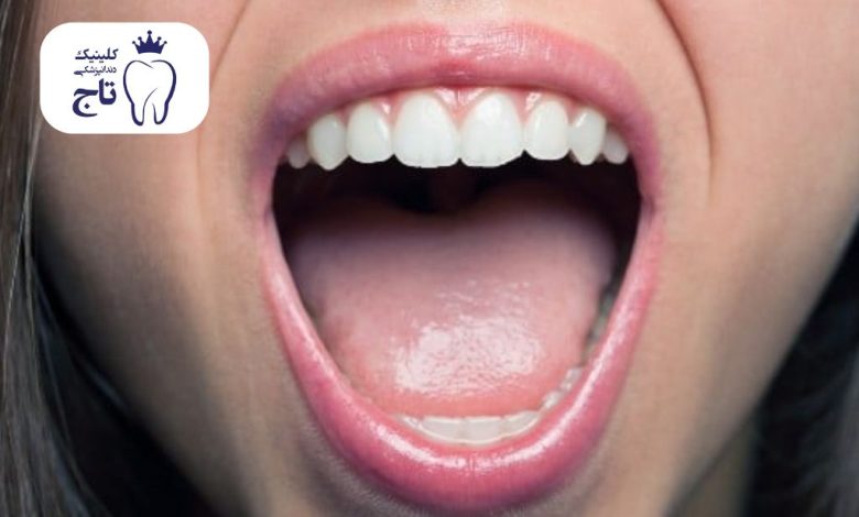 علت زیاد شدن بزاق دهان علت زیاد شدن بزاق دهان