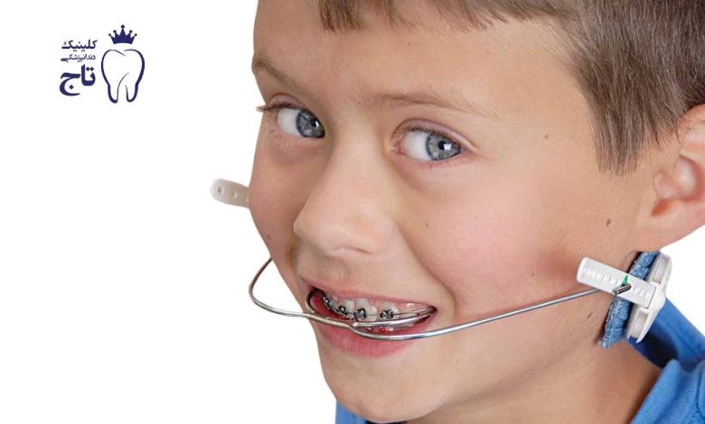 هدگیر ارتودنسی هدگیر ارتودنسی