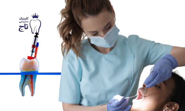 عصب ‌کشی دندان عقل