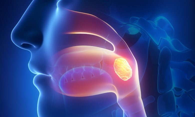 سنگ لوزه سنگ لوزه